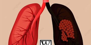 国民健康署扩大肺癌筛检服务，下修具肺癌家族史者筛检年龄(男性45岁、女性40岁)，并放宽重度吸烟者条件