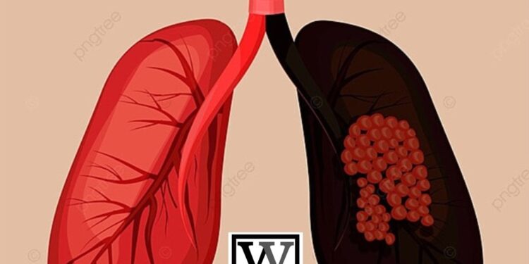 国民健康署扩大肺癌筛检服务，下修具肺癌家族史者筛检年龄(男性45岁、女性40岁)，并放宽重度吸烟者条件