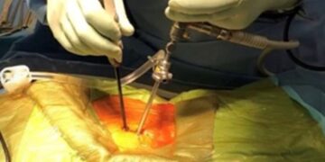 微创手术进行中